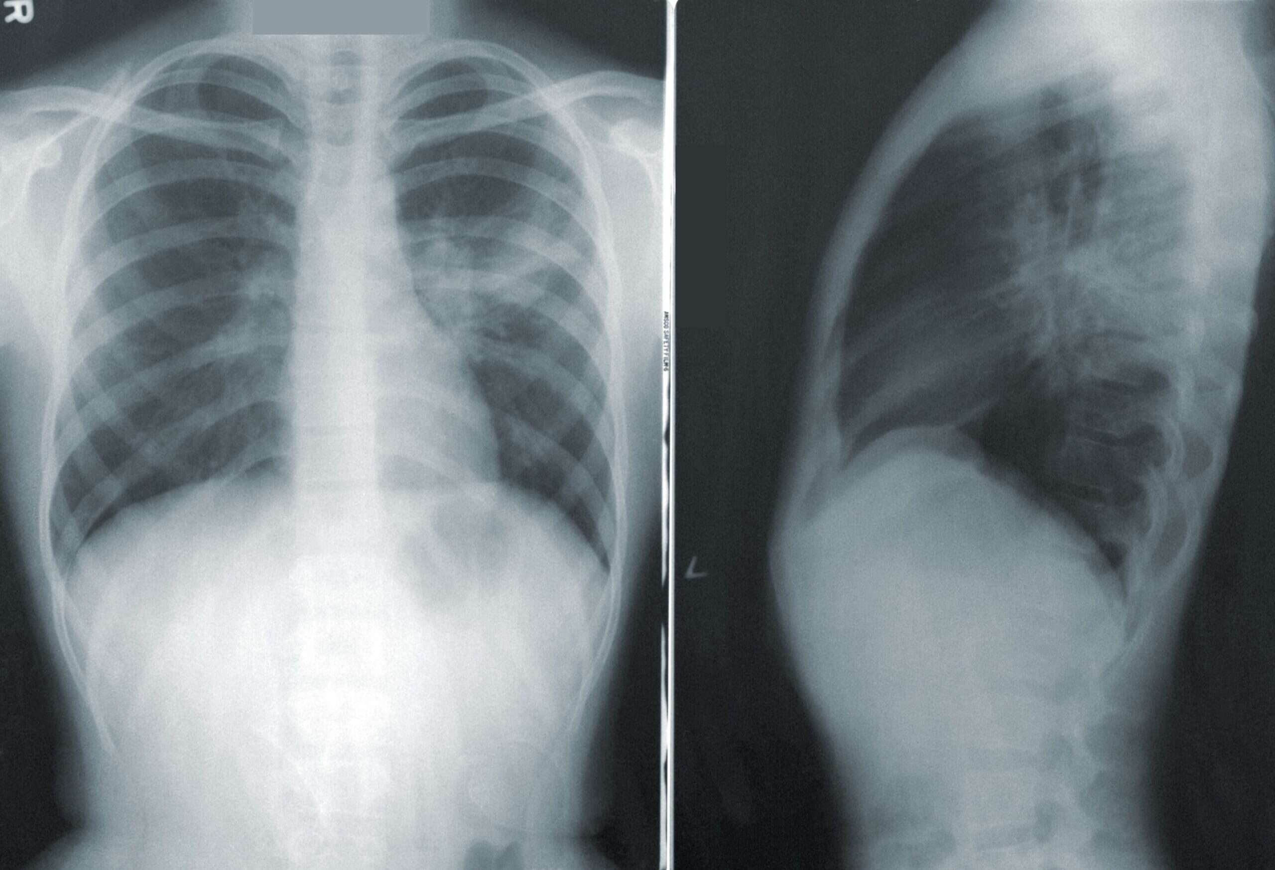 lung cancer screening