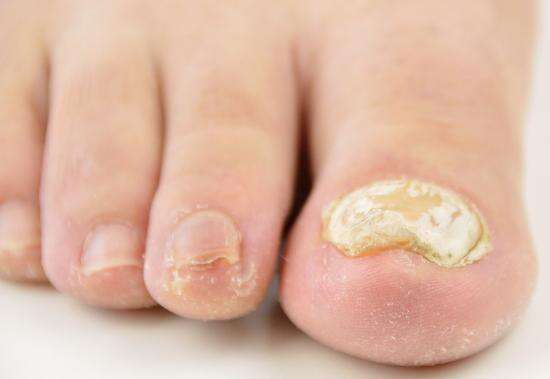 why-do-toenails-become-thick-medicalrecords