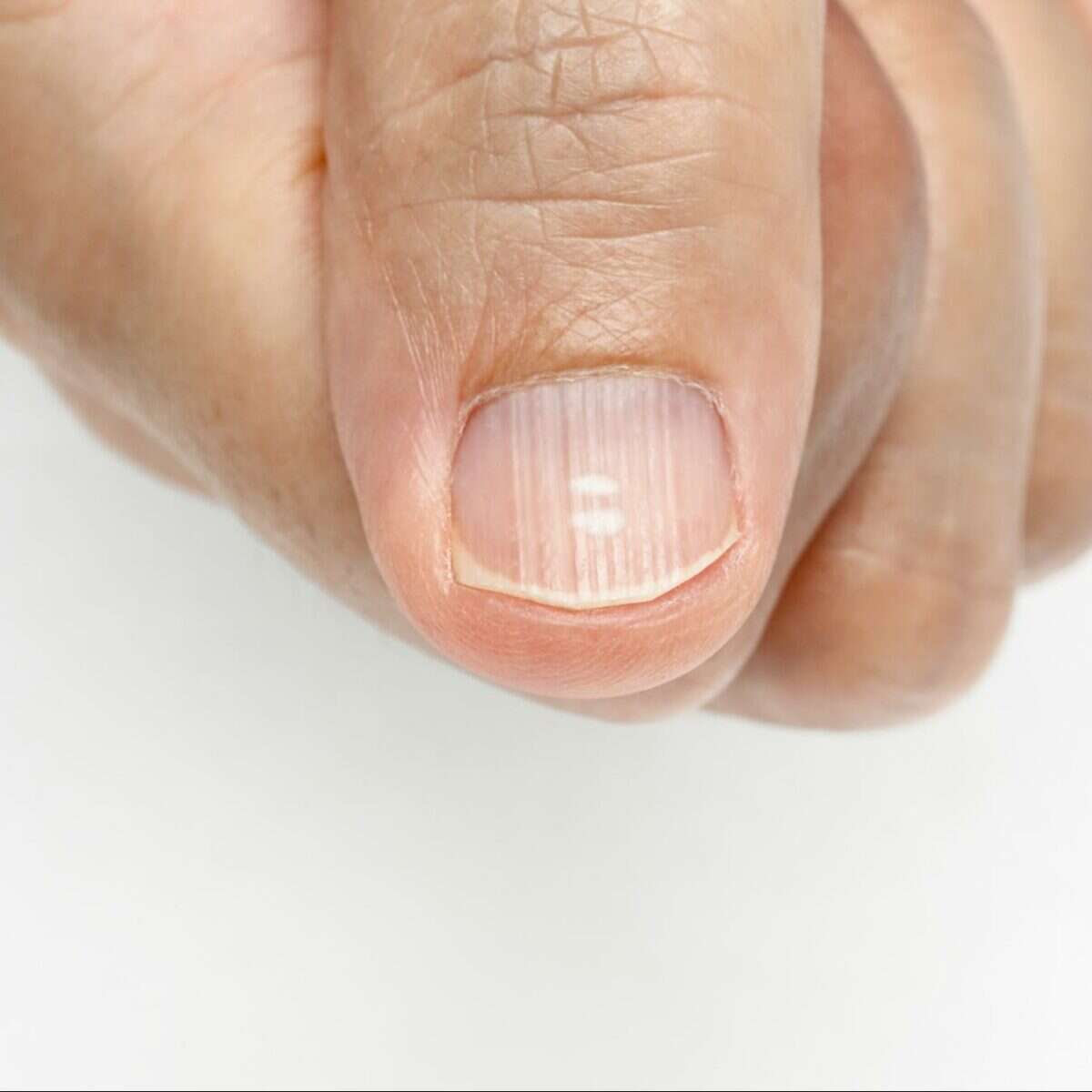 What Causes Ridges In Your Fingernails 
