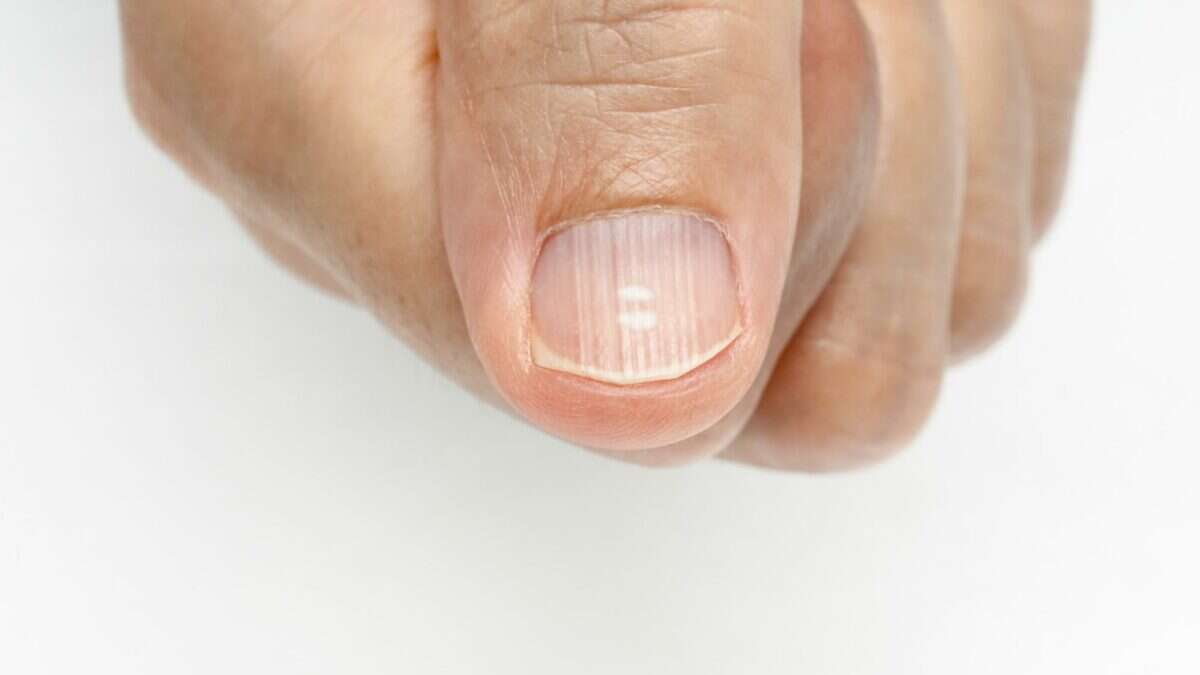 What Causes Ridges In Your Fingernails 