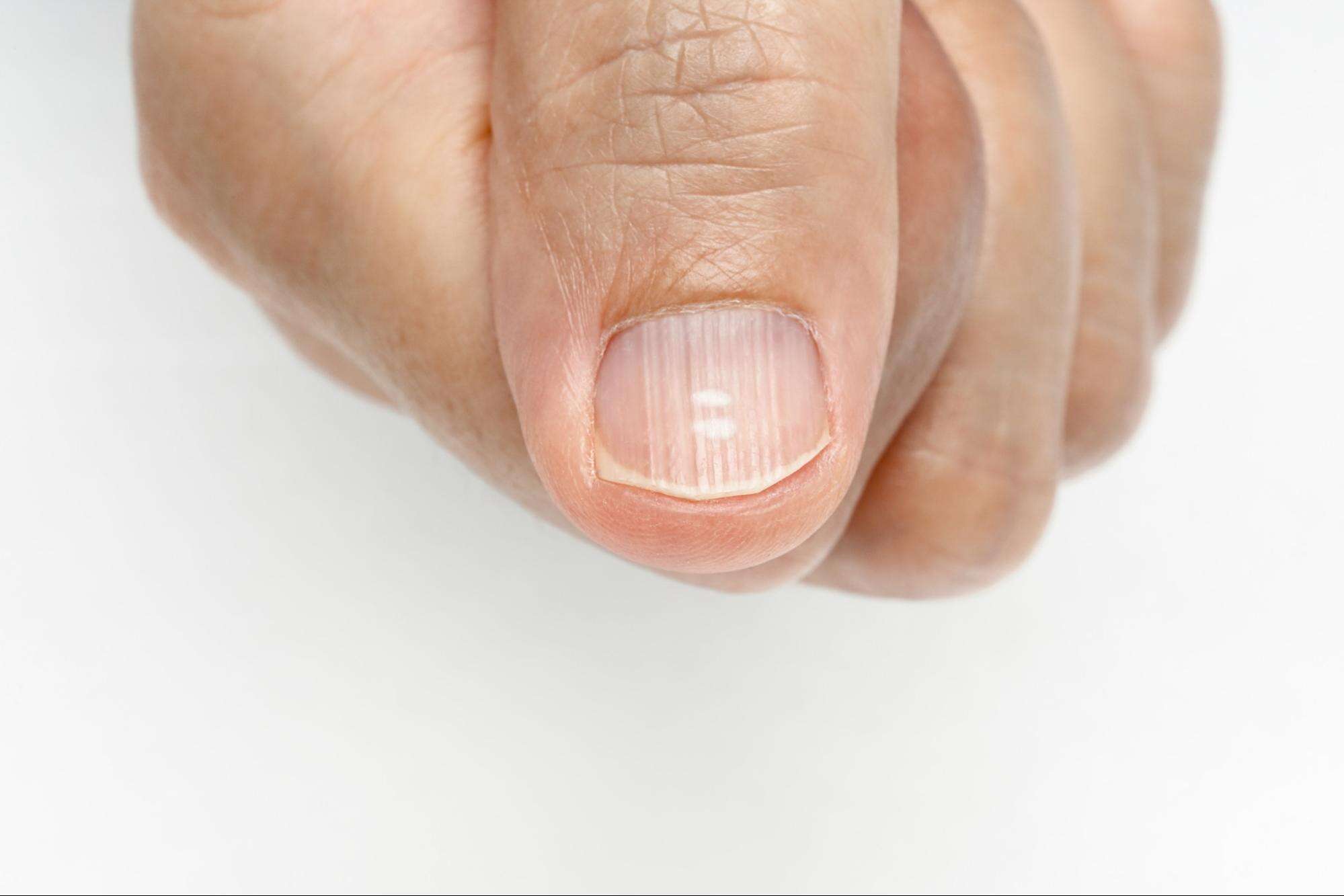Ridges in the fingernails, either horizontal or vertical, caused due to many reasons like aging.