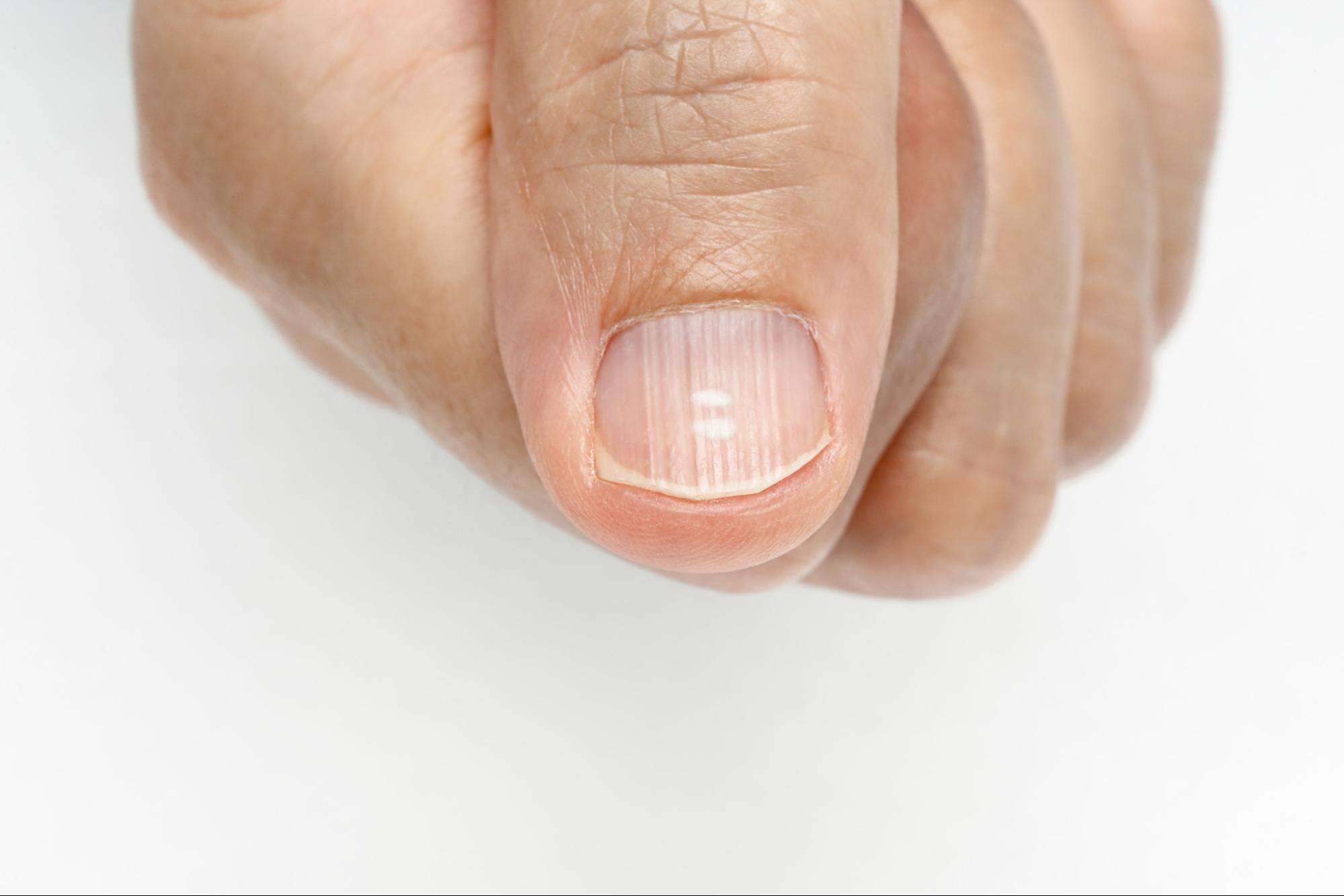 Black Line on Nails. Subungual Melanoma. Stock Photo - Image of care, line:  191856112